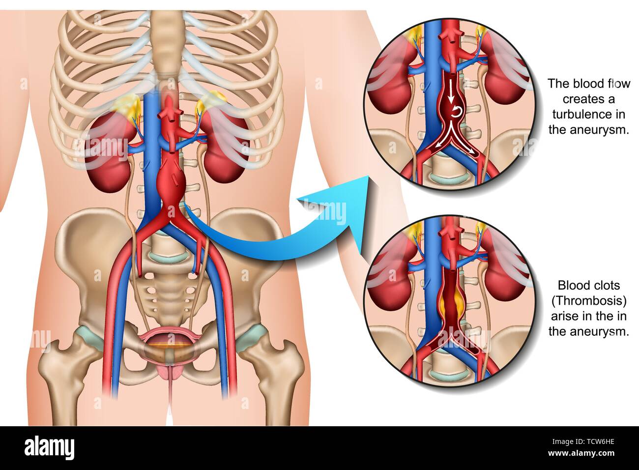 Aneurisma addominale medici Descrizione illustrazione vettoriale su sfondo bianco Illustrazione Vettoriale