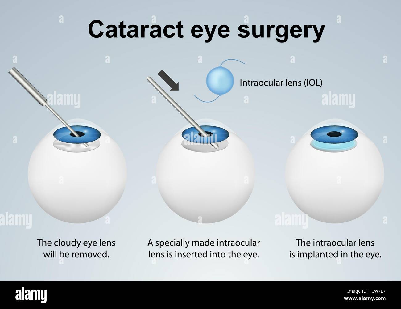 La cataratta chirurgia oculare processo medical illustrazione vettoriale isolato su sfondo grigio eps 10 Una infografica Illustrazione Vettoriale