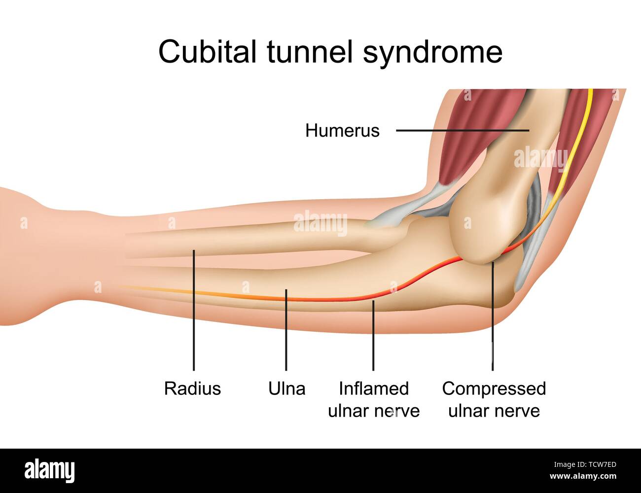 Cubital tunnel syndrome, infiammazione del nervo ulnare medical illustrazione vettoriale su sfondo bianco eps 10 Una infografica Illustrazione Vettoriale