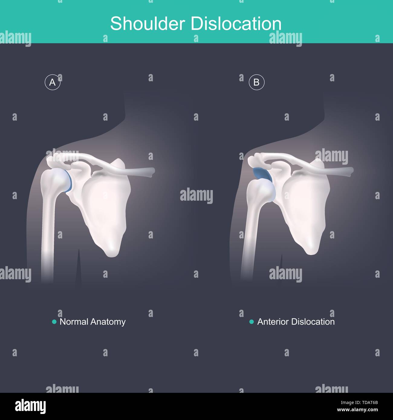 Le ossa umane spalla e testa omerale visto dalla parte anteriore. Illustrazione Vettoriale