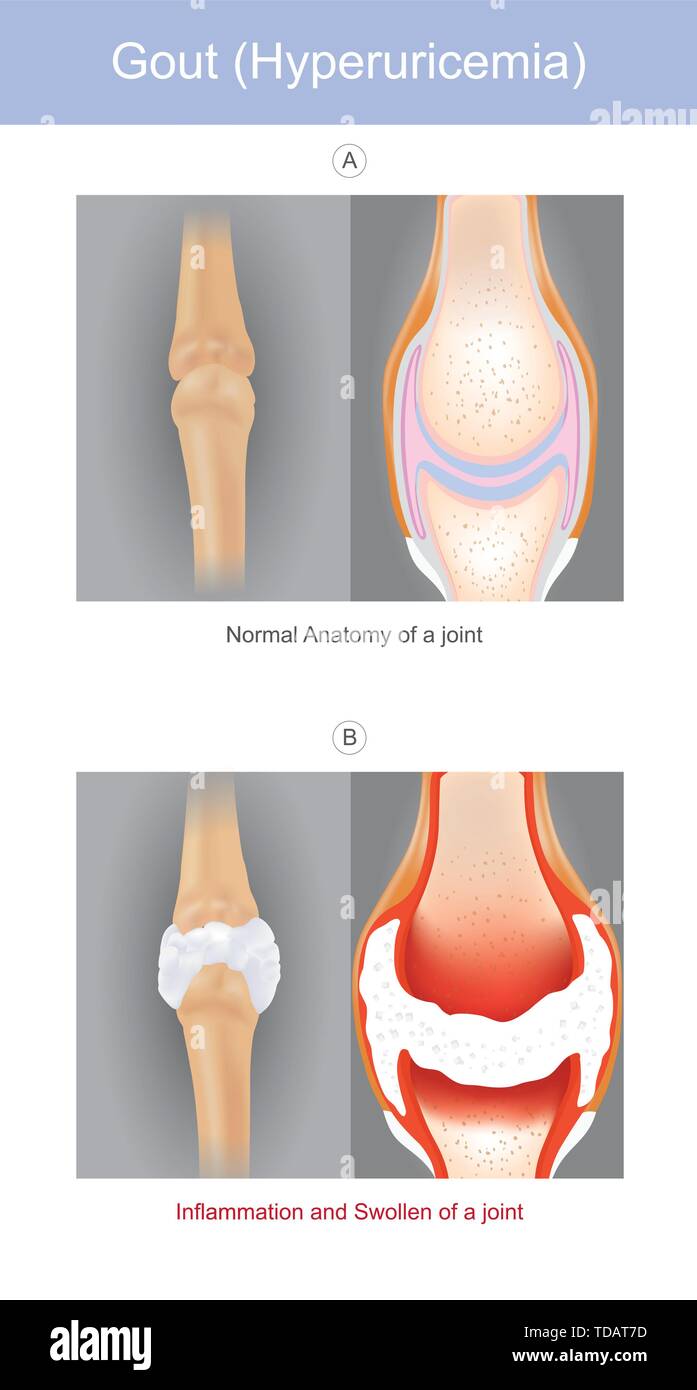 La illustrata una forma di artrite che può essere molto dolorosa è provocato dalla presenza di urato di sodio cristalli in articolazioni le dita mani o dita. Illustrazione Vettoriale