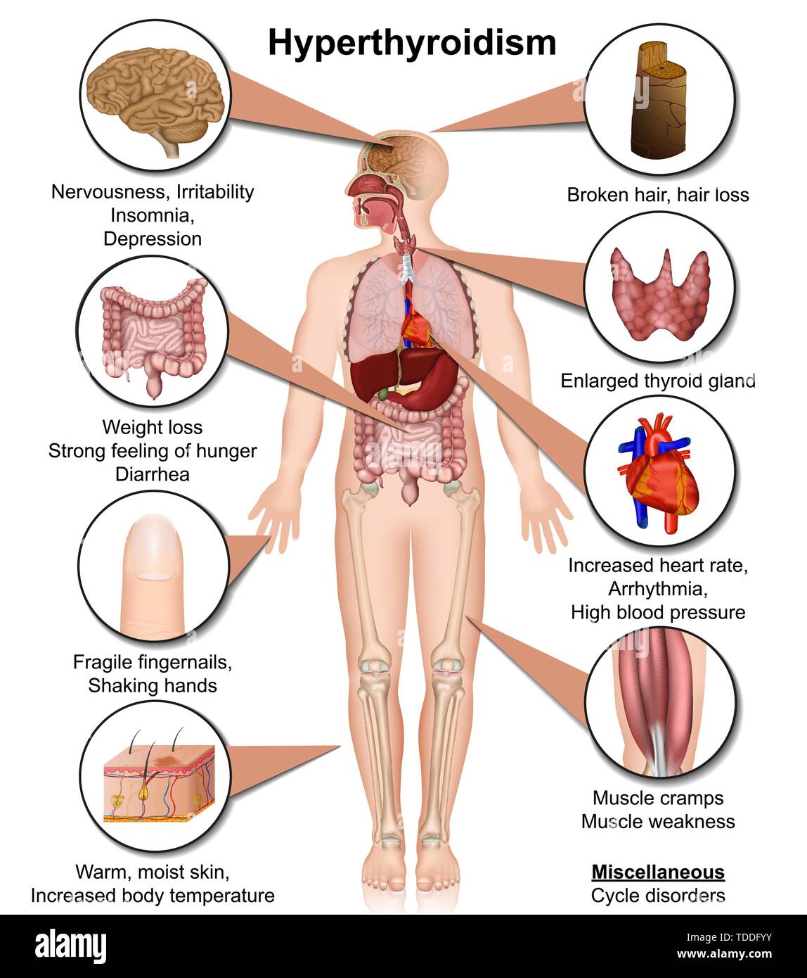 L'ipertiroidismo medical illustrazione vettoriale isolati su sfondo bianco Una infografica Illustrazione Vettoriale