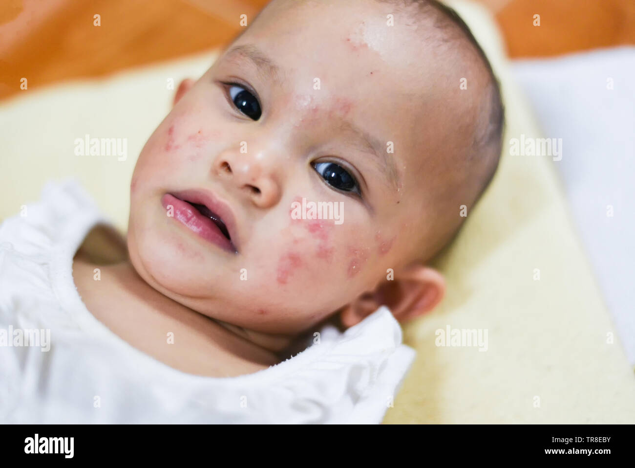 Rash baby allergy sulla faccia / malattia bambina viso Pelle secca prurito e  lesione causata da allergia in Asia neonato Foto stock - Alamy