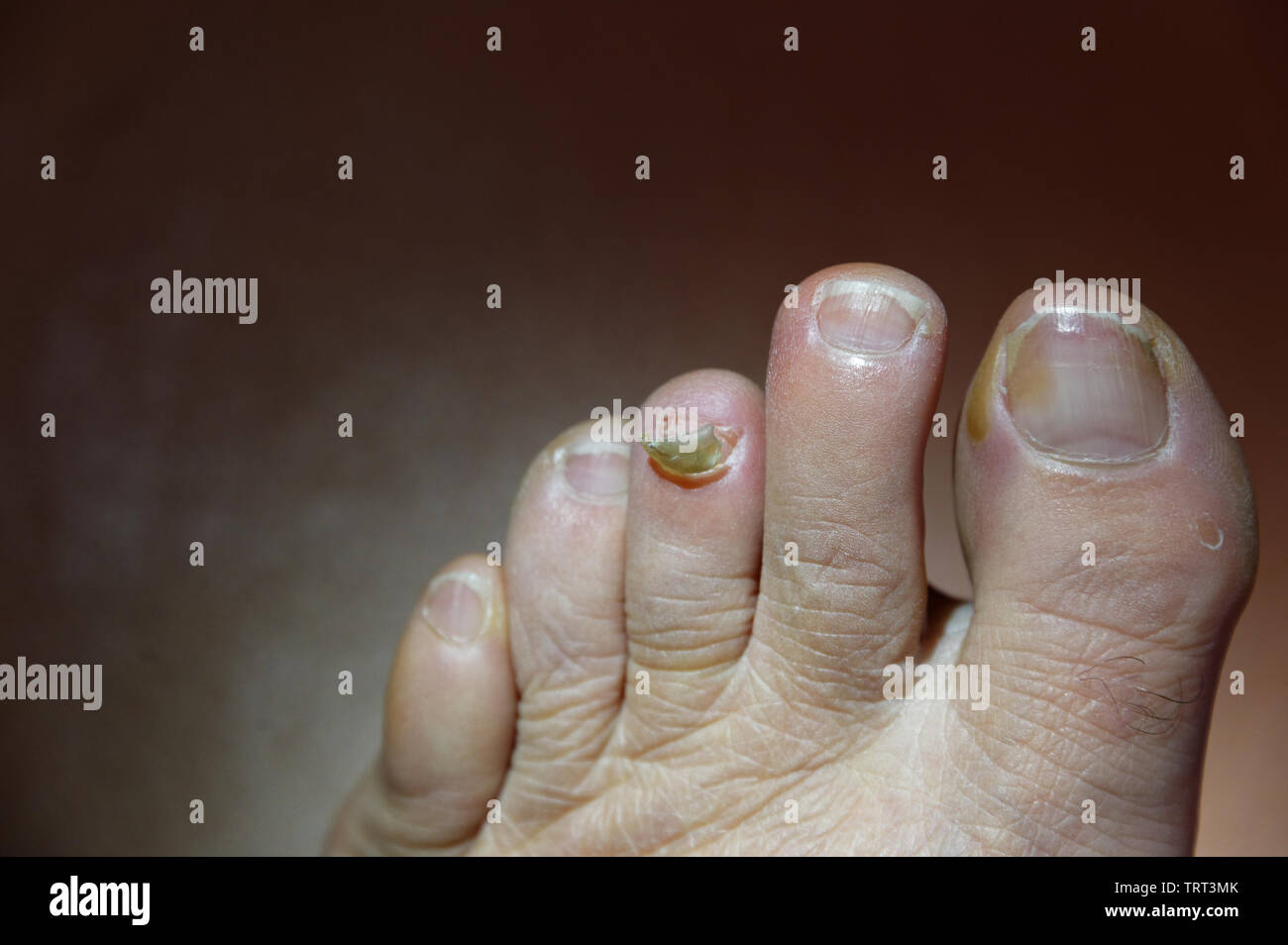 Un toe ha quasi perso il suo toenail, è appeso alla base Foto Stock