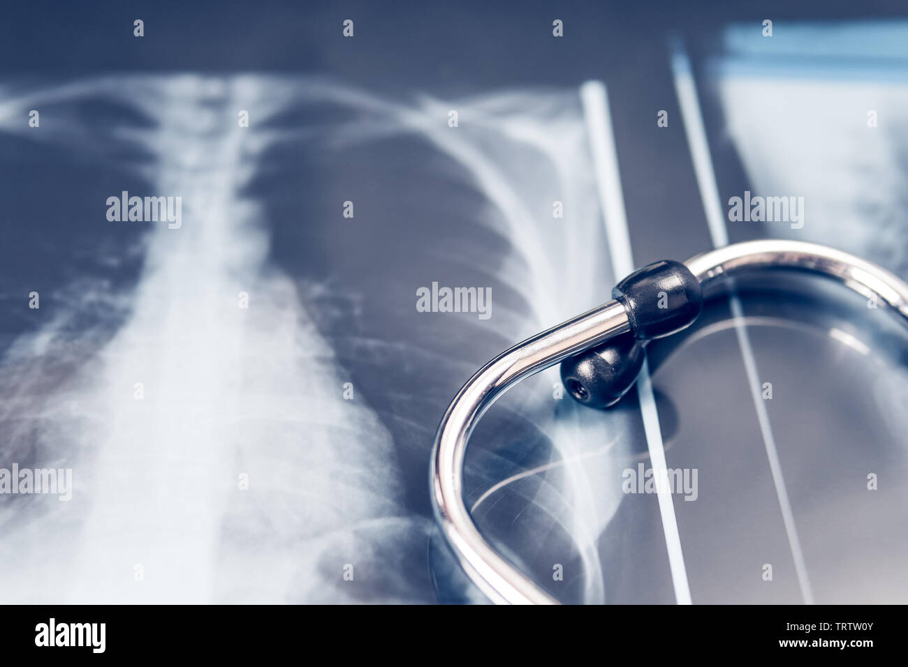 X-ray dei polmoni con stetoscopio. concetto malattia polmonare. Foto Stock