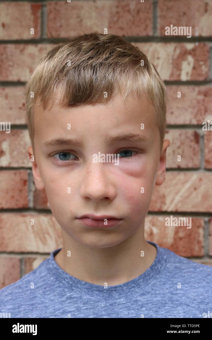 Ritratto di un giovane ragazzo con gonfiore del viso a causa di hornet sting Foto Stock