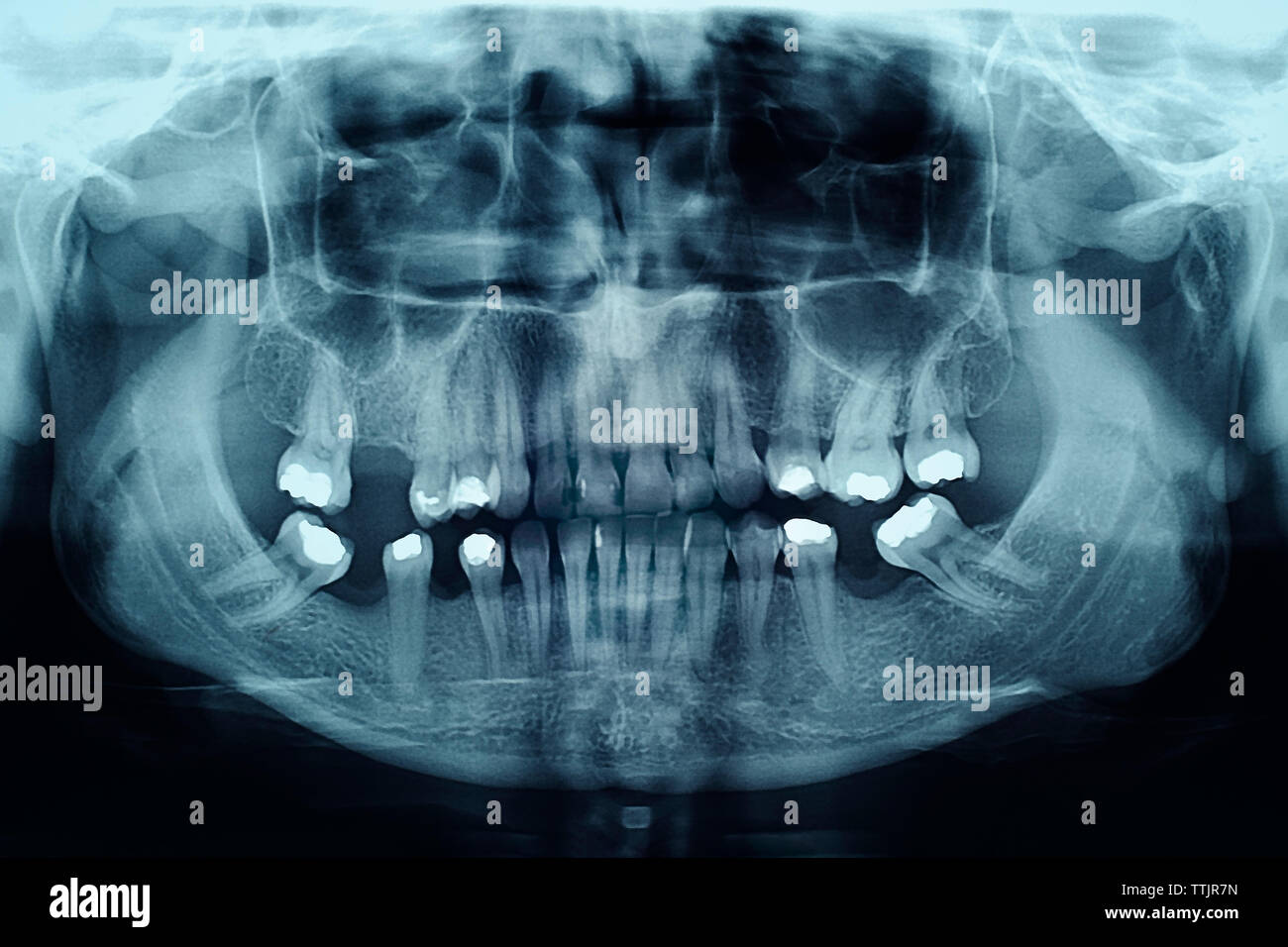 Apparecchiature odontoiatriche a raggi X che mostra i riempimenti in denti Foto Stock