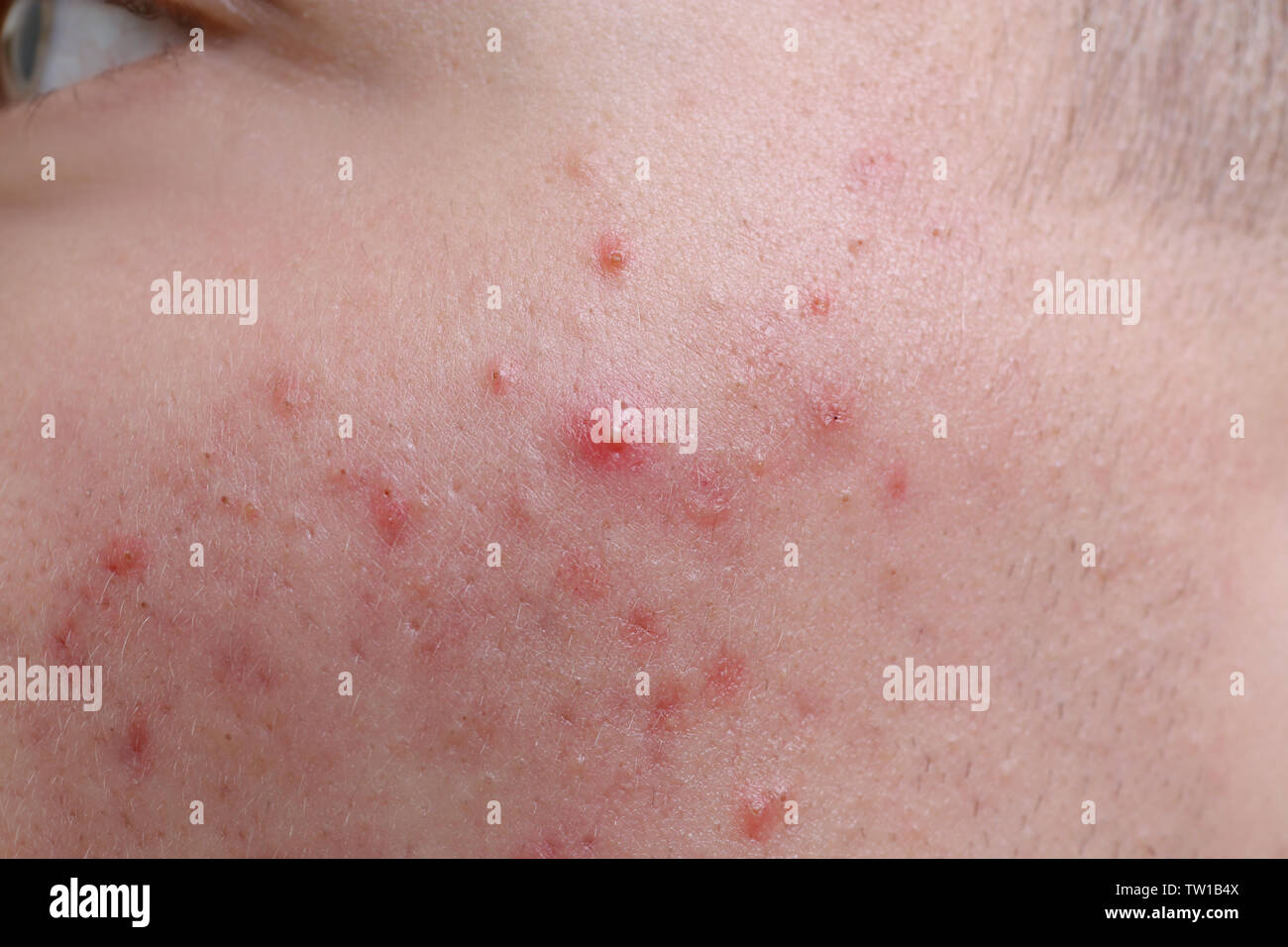 La pelle umana con acne, primo piano Foto Stock