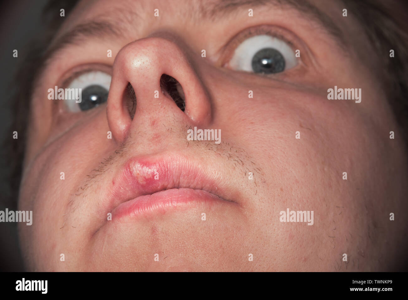 Big scary occhi e herpes sul labbro superiore. Uomo caucasico Foto Stock