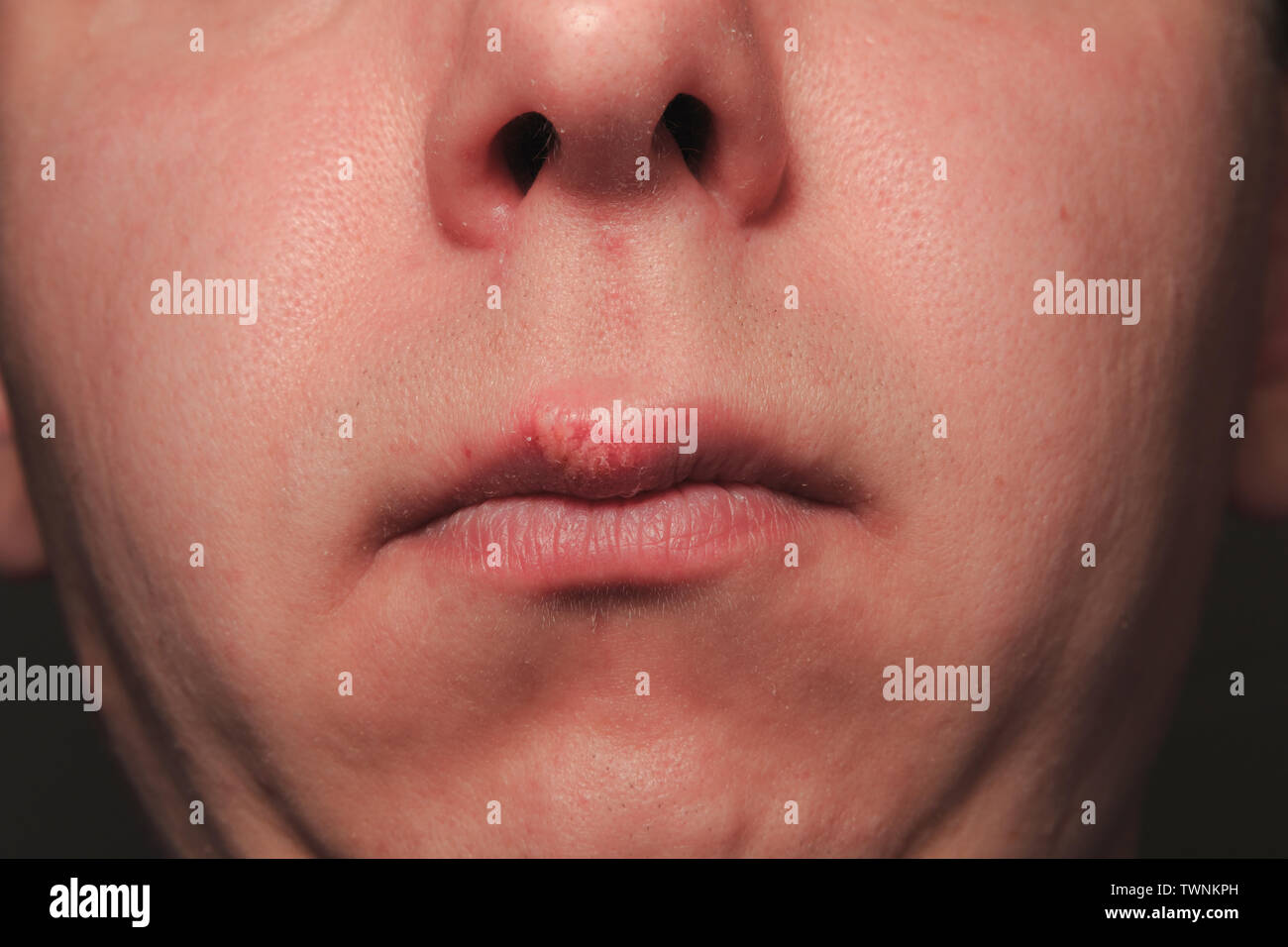 Secondo giorno di crescente herpes su caucasica uomo maschio sul lato anteriore di un labbro superiore Foto Stock