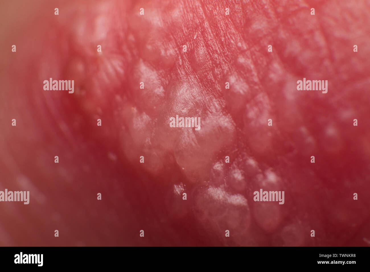 Inizio della coltivazione di herpes su caucasica uomo maschio sul lato anteriore di un labbro superiore super microscopio macro Foto Stock