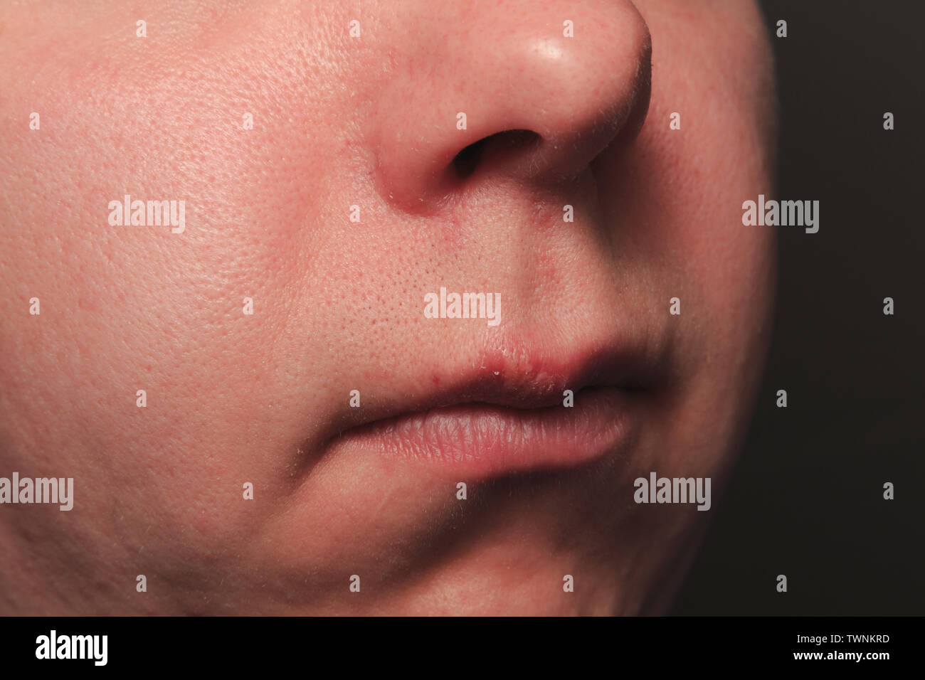 Secondo giorno di crescente herpes su caucasica uomo maschio sul lato anteriore di un labbro superiore Foto Stock