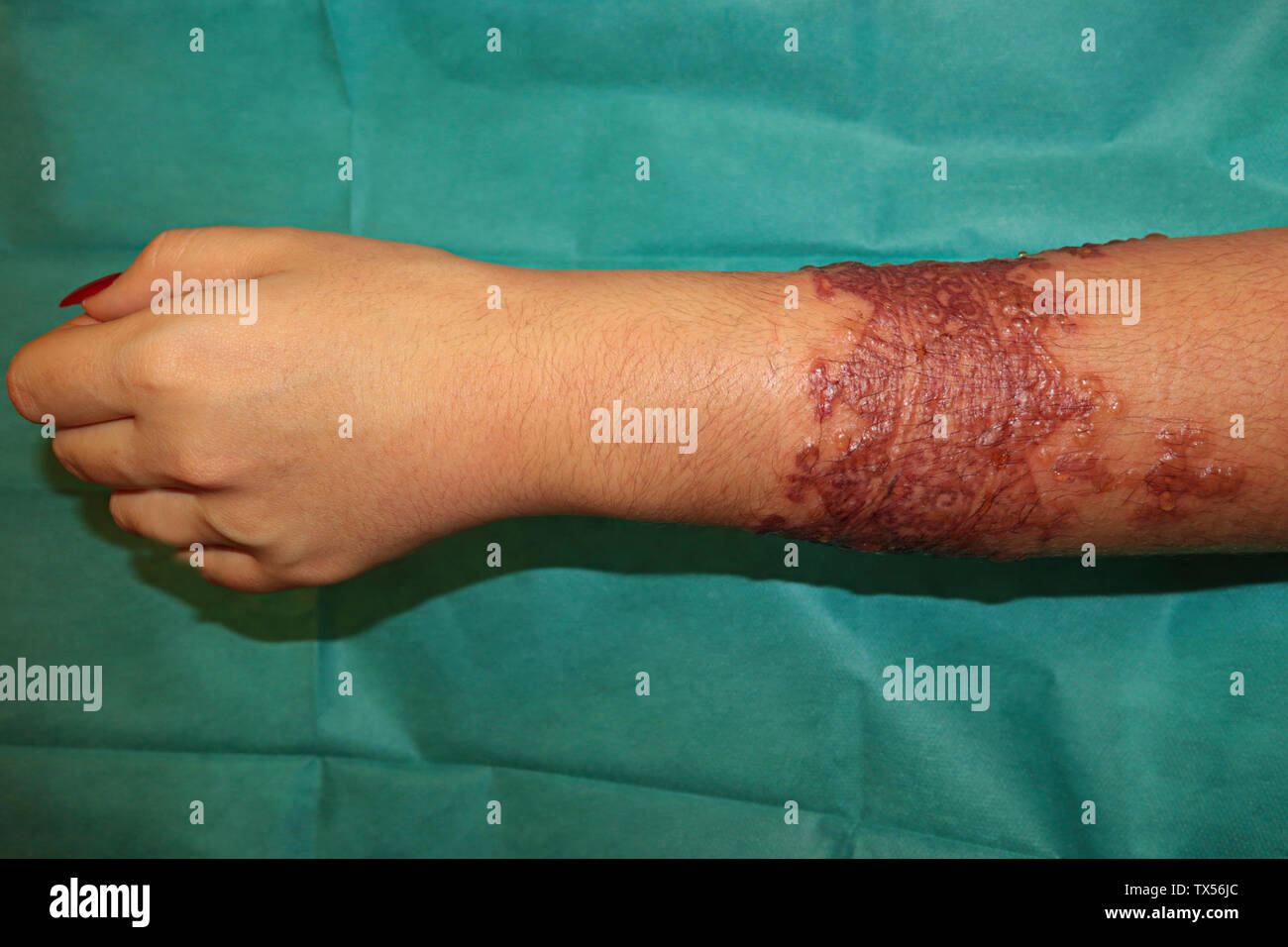 Réaction allergique ponderosa après tatouage onu au henné Foto Stock