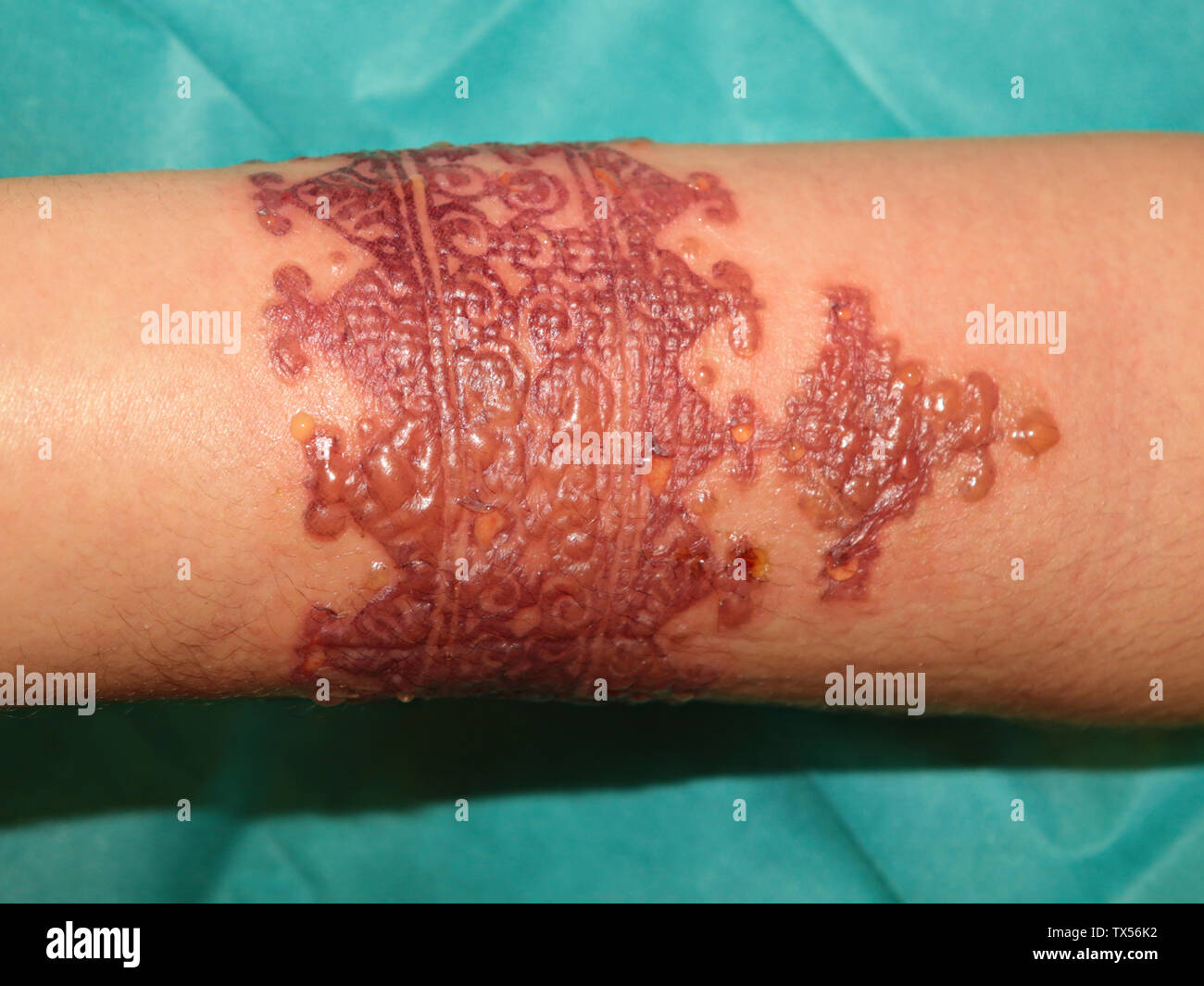 Réaction allergique ponderosa après tatouage onu au henné Foto Stock