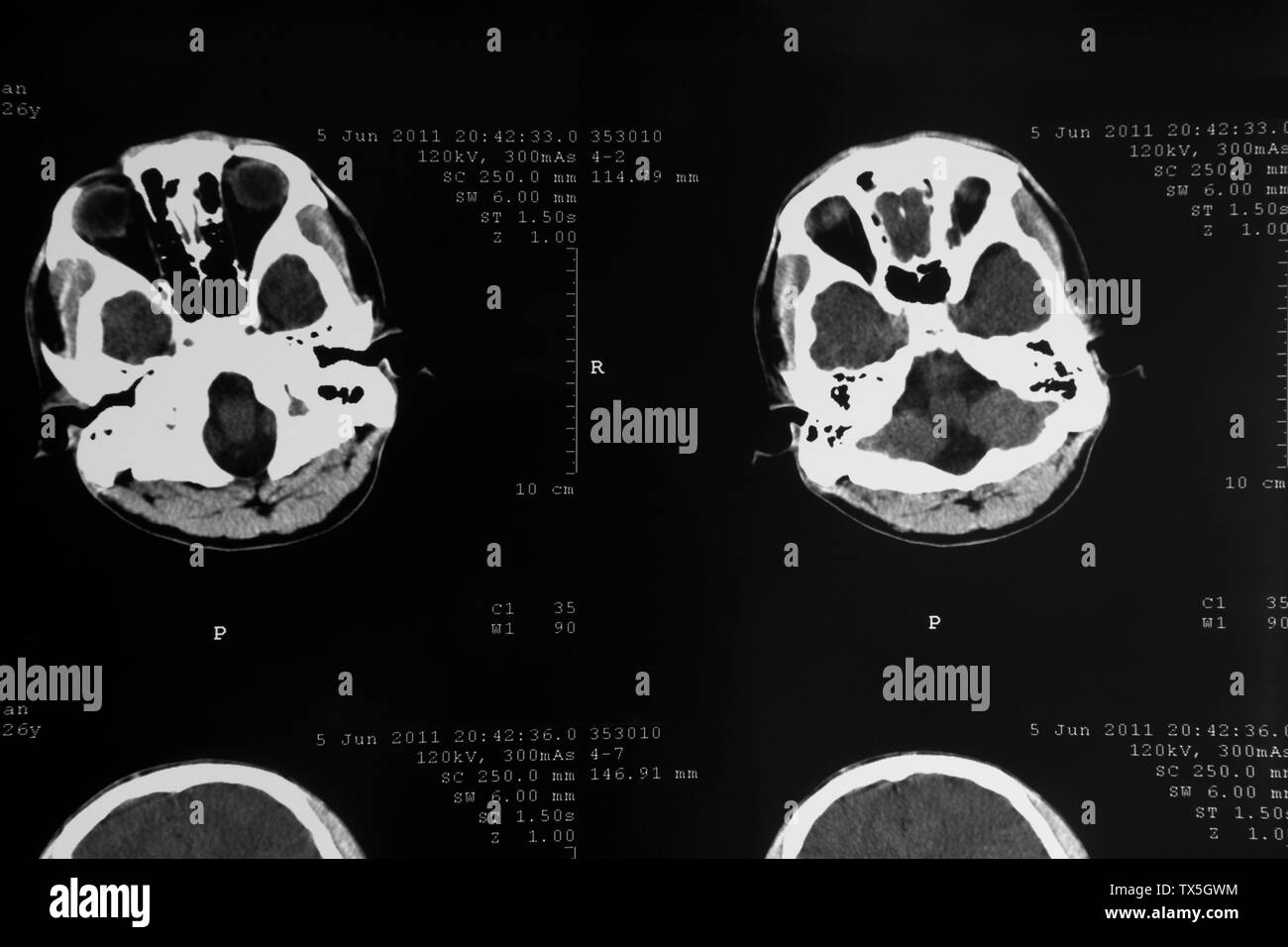 Tomogram MRI del cervello umano Foto Stock
