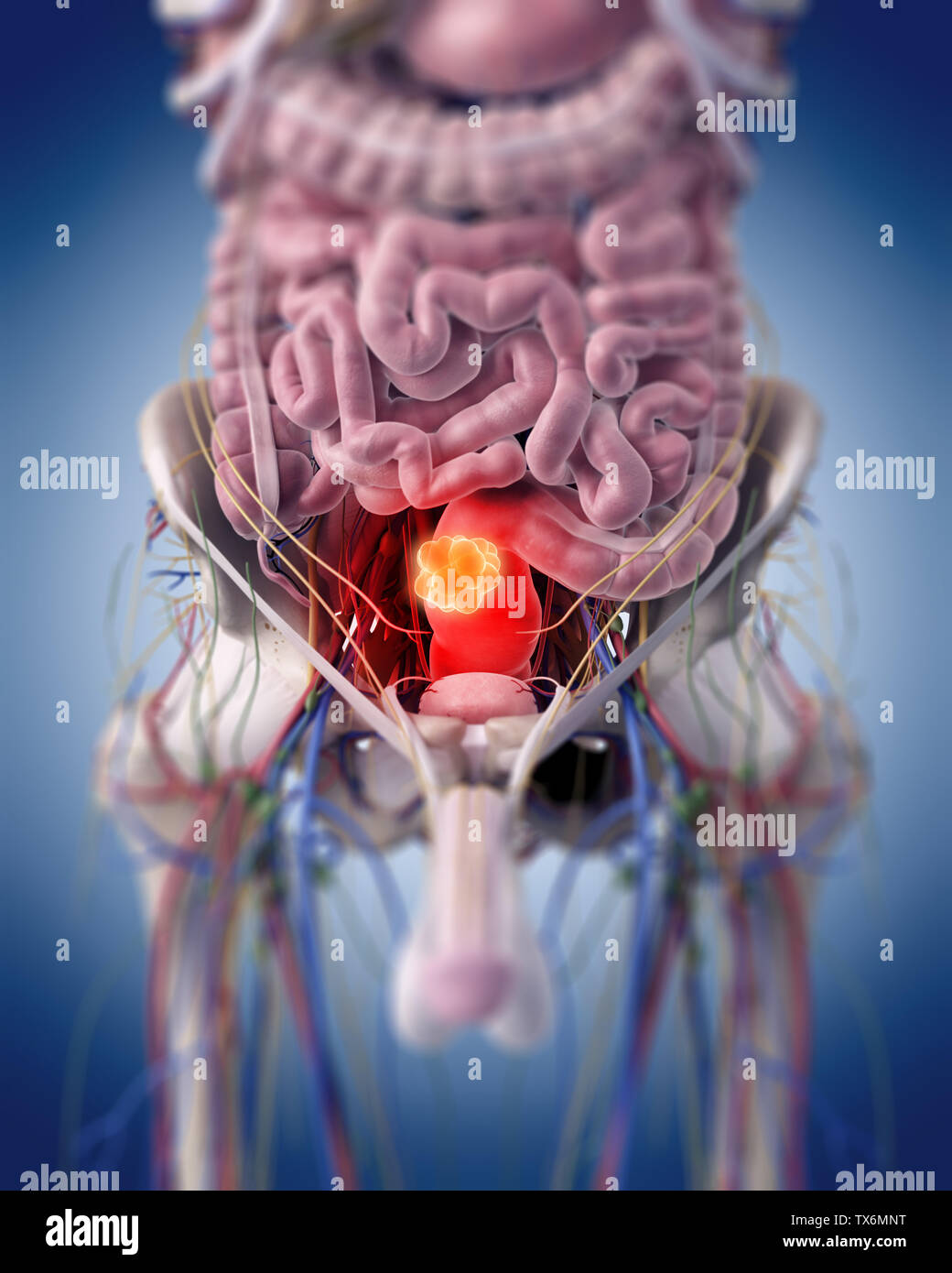 3D Rendering accurato dal punto di vista medico illustrazione di un tumore rettale Foto Stock