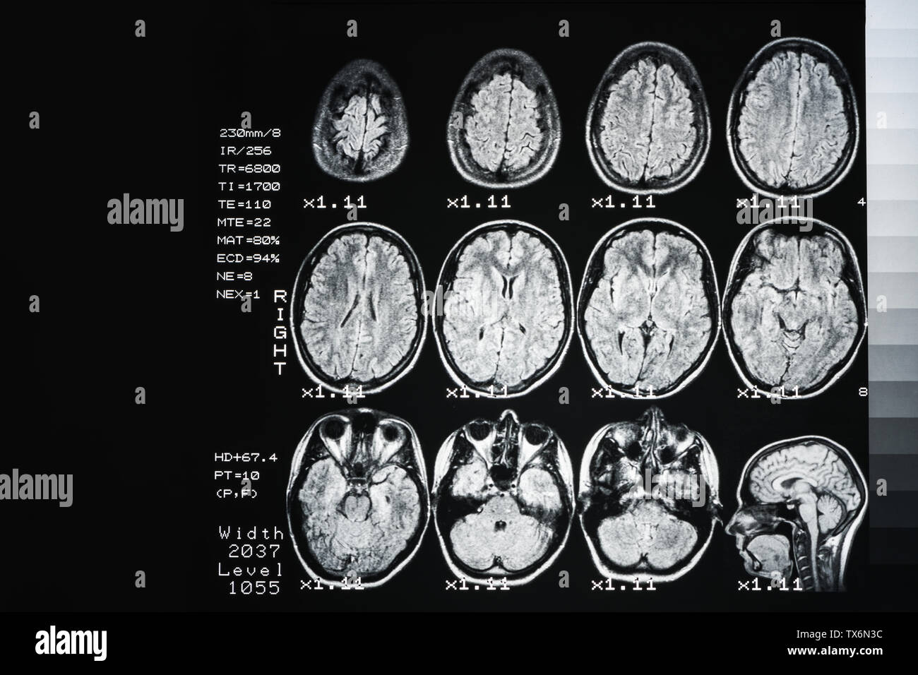 Il risultato è un MRI del cervello con i valori e i numeri. Medico di fondo Foto Stock