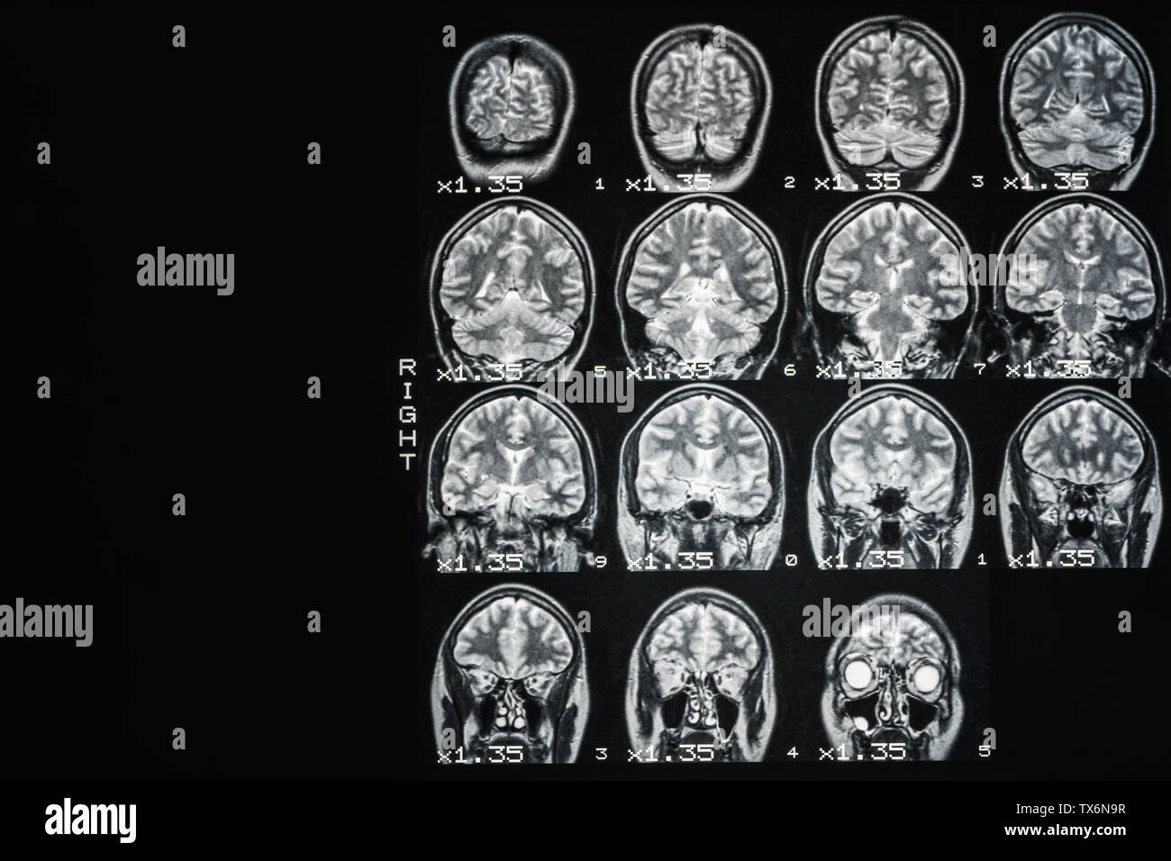 MRI del cervello di una persona sana su uno sfondo nero con retroilluminazione di colore grigio. Medico di fondo Foto Stock