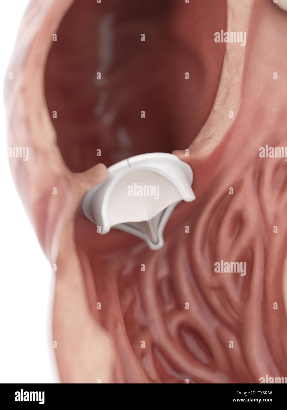 3D Rendering accurato dal punto di vista medico illustrazione di una valvola cardiaca artificiale Foto Stock