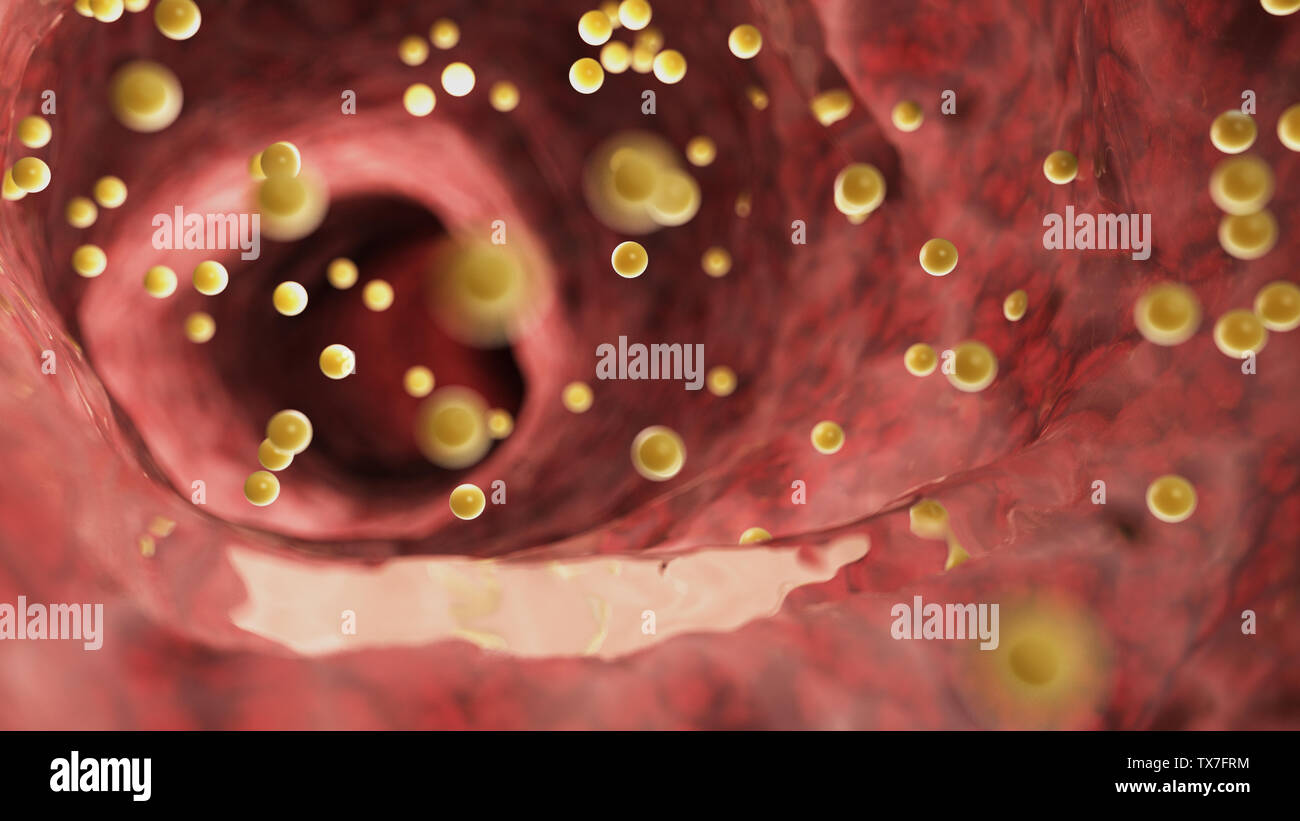 3D Rendering accurato dal punto di vista medico illustrazione del colon infiammazione causata da glutine Foto Stock