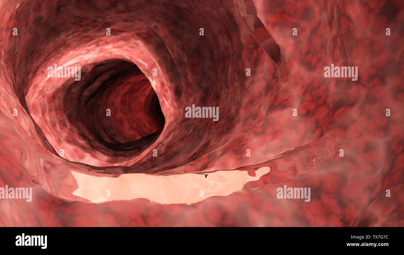 3D Rendering accurato dal punto di vista medico illustrazione di un'infiammazione del colon Foto Stock
