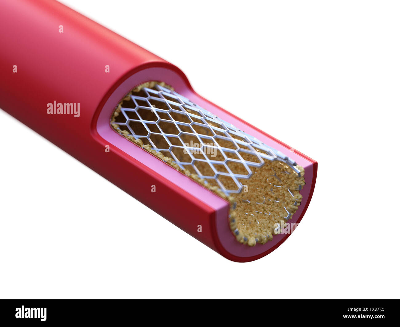 3D Rendering accurato dal punto di vista medico illustrazione dello stent collocati in una arteria Foto Stock