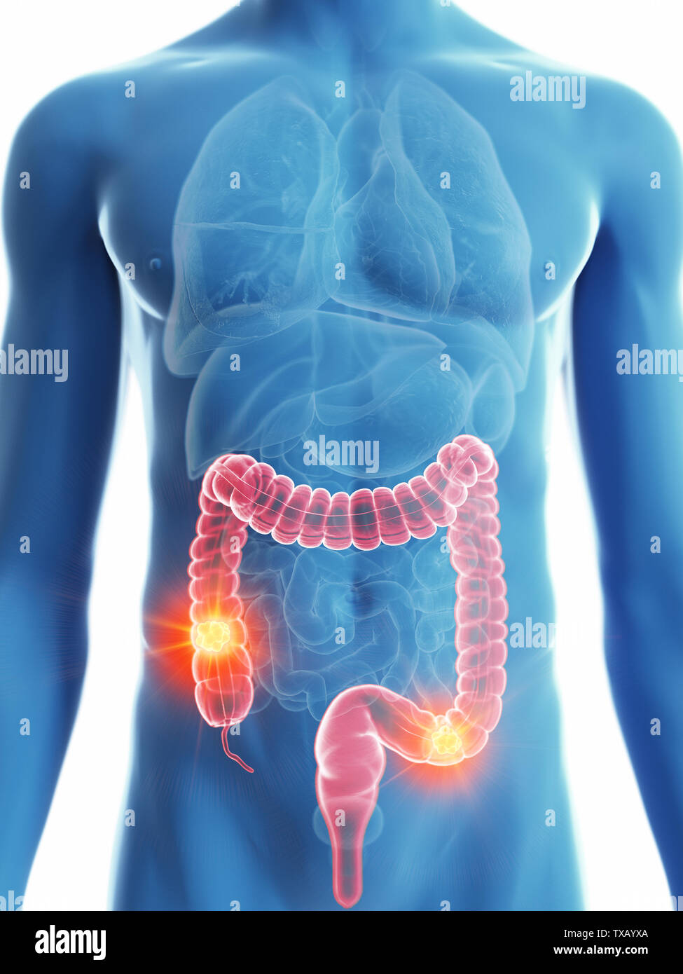 3D Rendering accurato dal punto di vista medico illustrazione di un mans cancro al colon Foto Stock