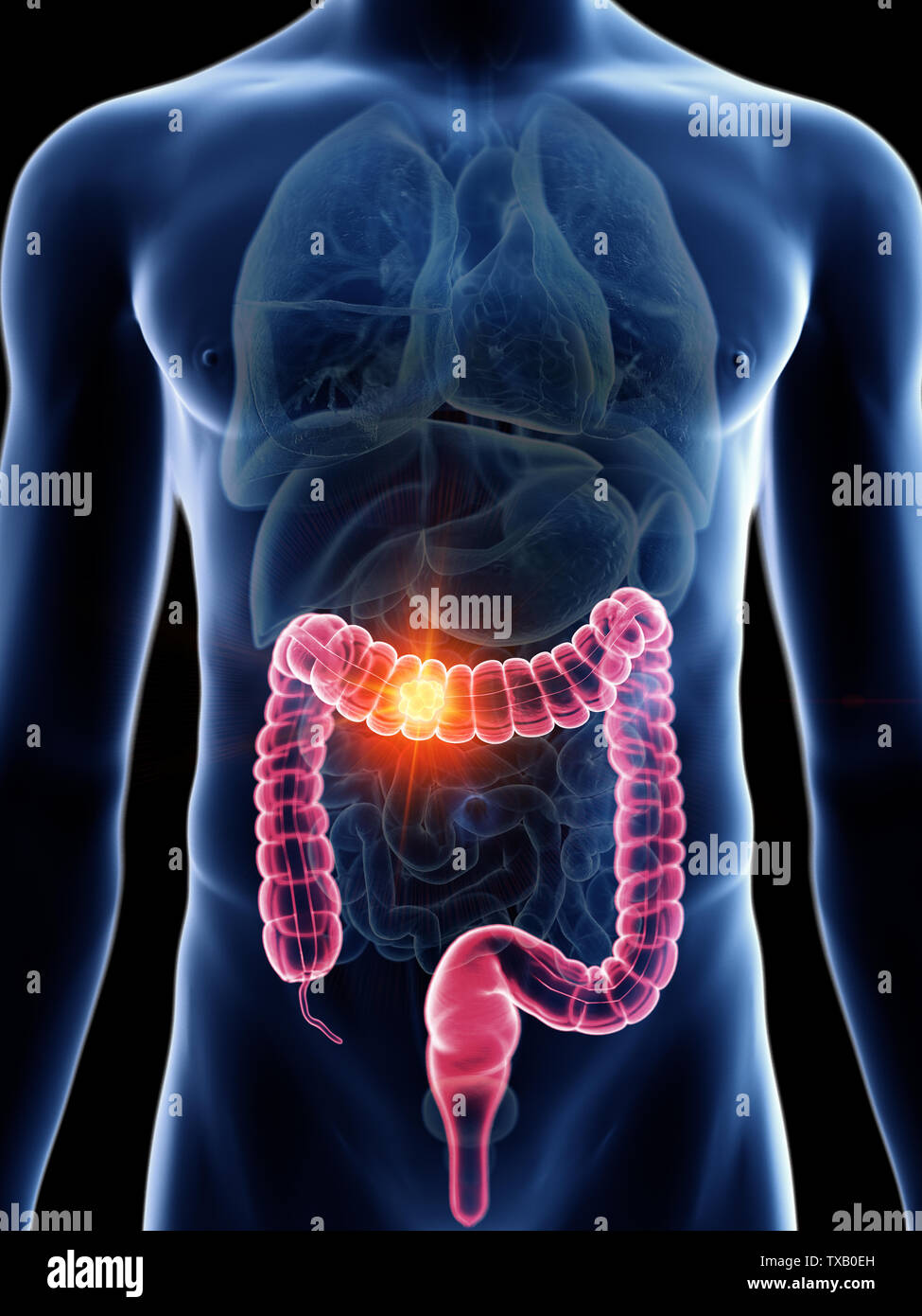 3D Rendering accurato dal punto di vista medico illustrazione di un mans cancro al colon Foto Stock