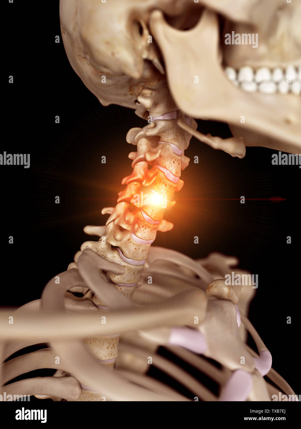 3D Rendering accurato dal punto di vista medico illustrazione di un doloroso collo Foto Stock
