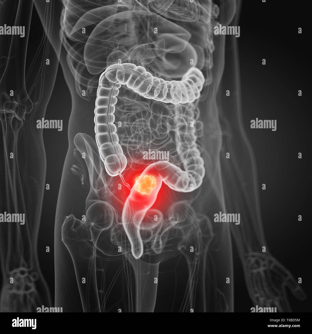 3D Rendering accurato dal punto di vista medico illustrazione di cancro al colon Foto Stock