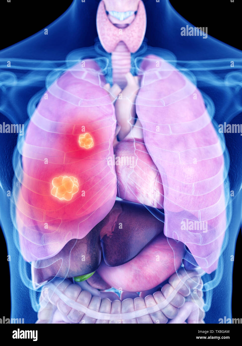 3D Rendering accurato dal punto di vista medico illustrazione del cancro ai polmoni Foto Stock