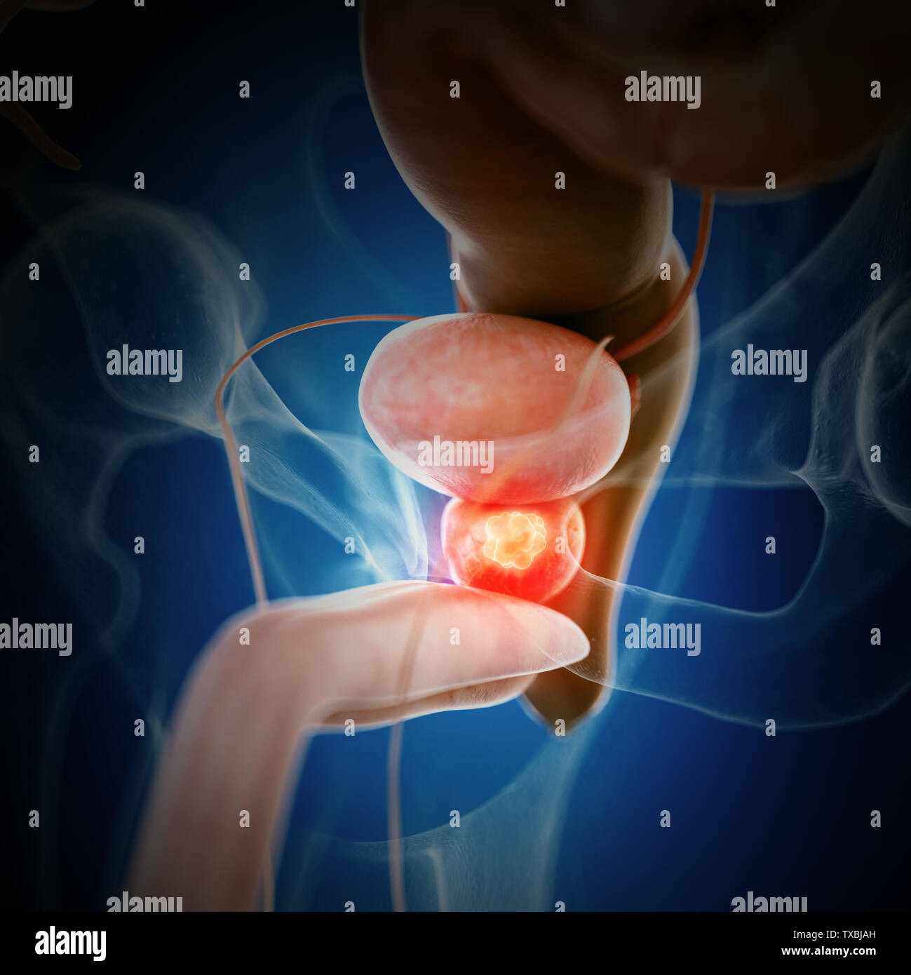 3D Rendering accurato dal punto di vista medico illustrazione del cancro della prostata Foto Stock