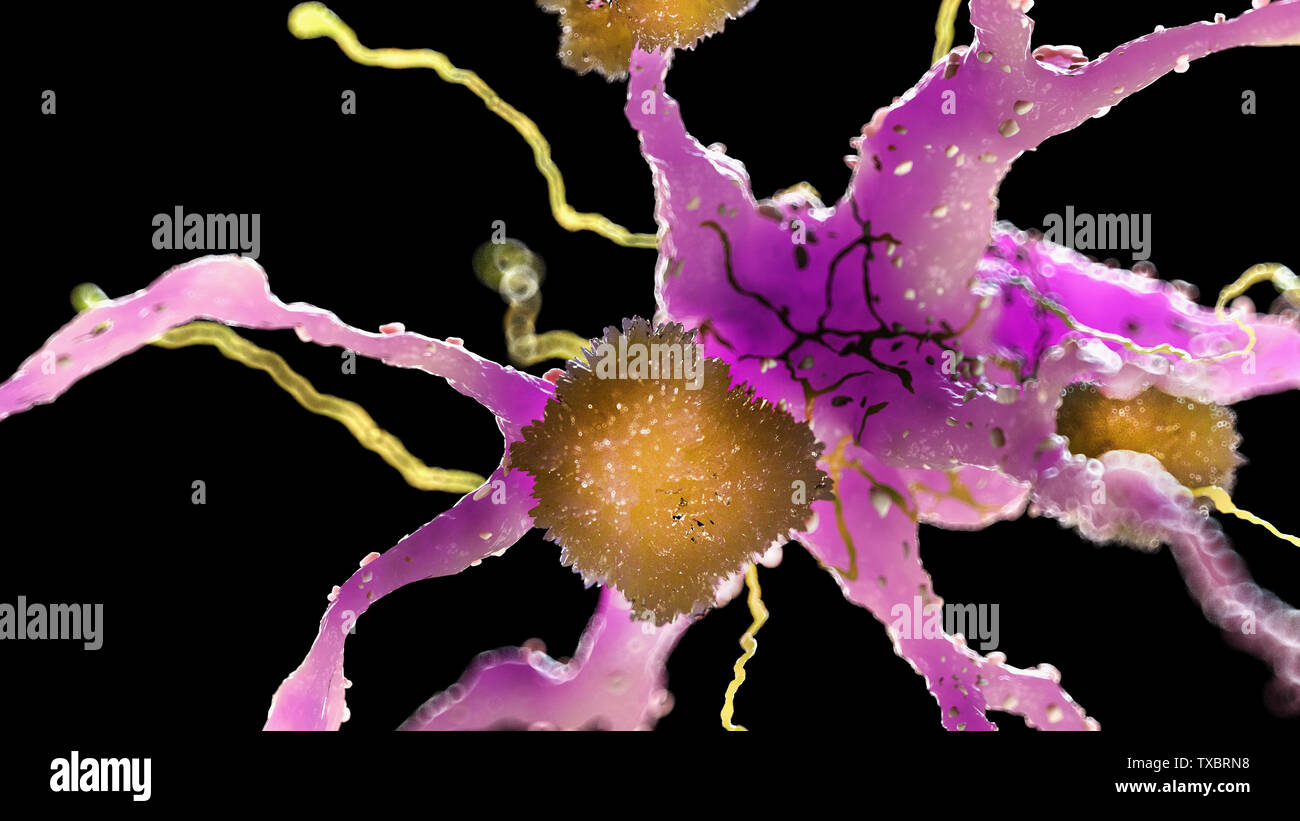 3D Rendering accurato dal punto di vista medico illustrazione delle placche amiloidi su un morbo di Alzheimer cellula nervosa Foto Stock