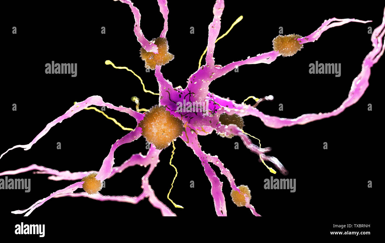 3D Rendering accurato dal punto di vista medico illustrazione delle placche amiloidi su un morbo di Alzheimer cellula nervosa Foto Stock