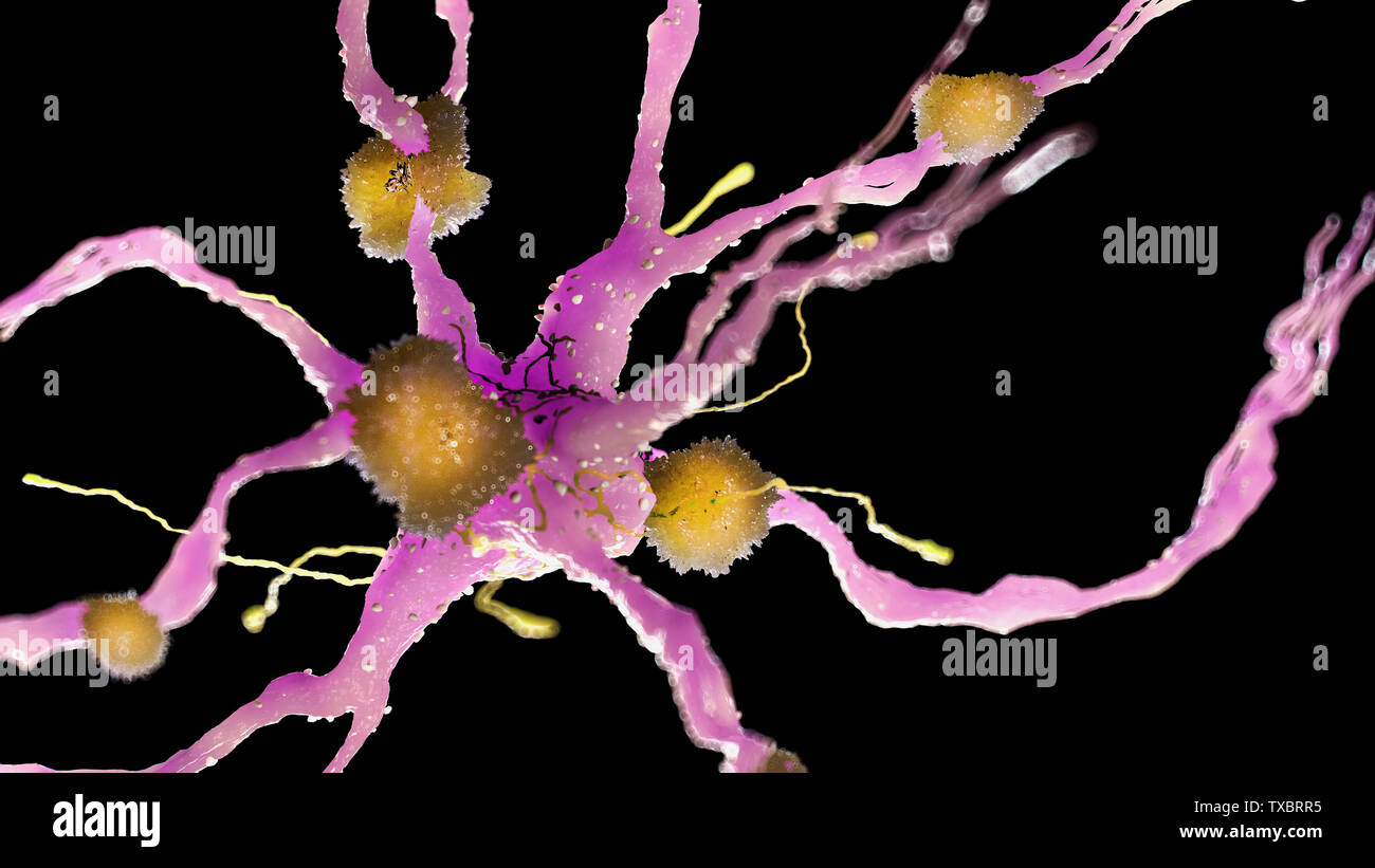 3D Rendering accurato dal punto di vista medico illustrazione delle placche amiloidi su un morbo di Alzheimer cellula nervosa Foto Stock
