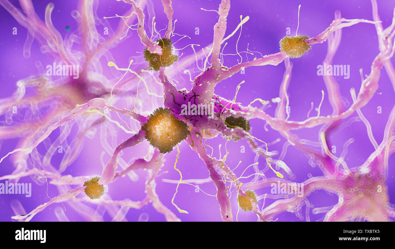 3D Rendering accurato dal punto di vista medico illustrazione delle placche amiloidi su un morbo di Alzheimer cellula nervosa Foto Stock