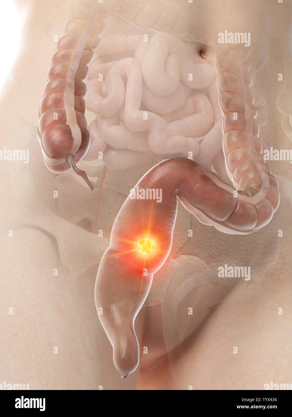 3D Rendering accurato dal punto di vista medico illustrazione di una donna con il cancro al colon Foto Stock