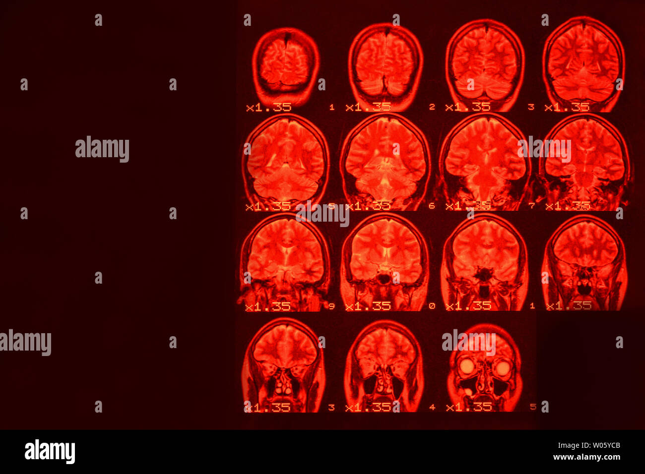 MRI del cervello su uno sfondo nero con retroilluminazione rossa. Medico di fondo Foto Stock