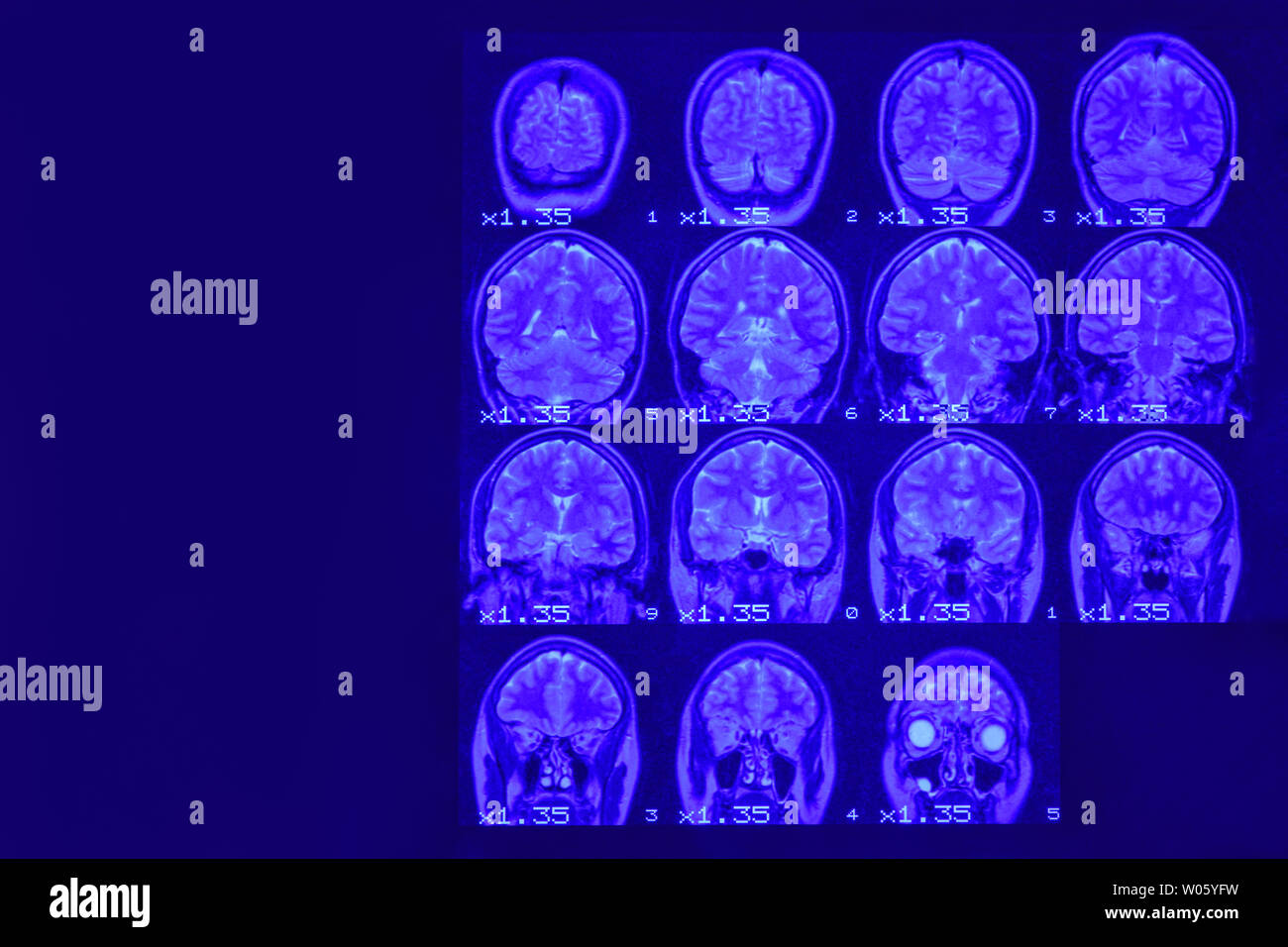 MRI del cervello su uno sfondo nero con retroilluminazione blu. Posto a sinistra per la pubblicità di iscrizione Foto Stock