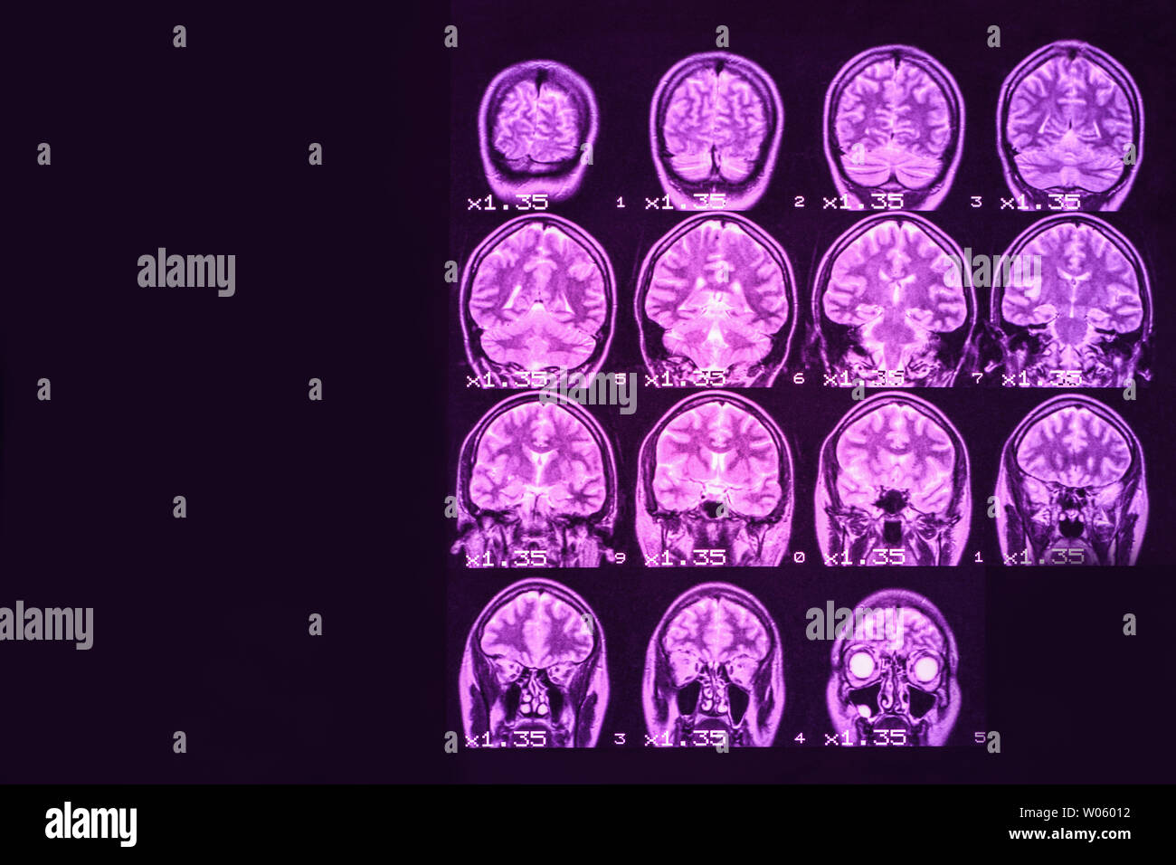 MRI del cervello su uno sfondo nero con retroilluminazione color porpora. Posto a sinistra per la pubblicità di iscrizione Foto Stock