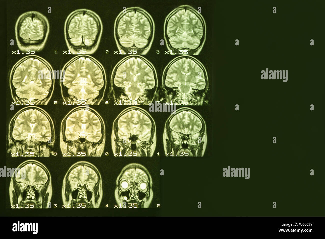 MRI del cervello su uno sfondo nero con retroilluminazione di colore giallo. Il posto giusto per pubblicità iscrizione Foto Stock