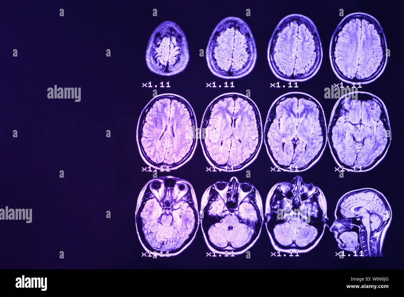 MRI del cervello su uno sfondo nero con retroilluminazione blu. Il posto giusto per pubblicità iscrizione Foto Stock