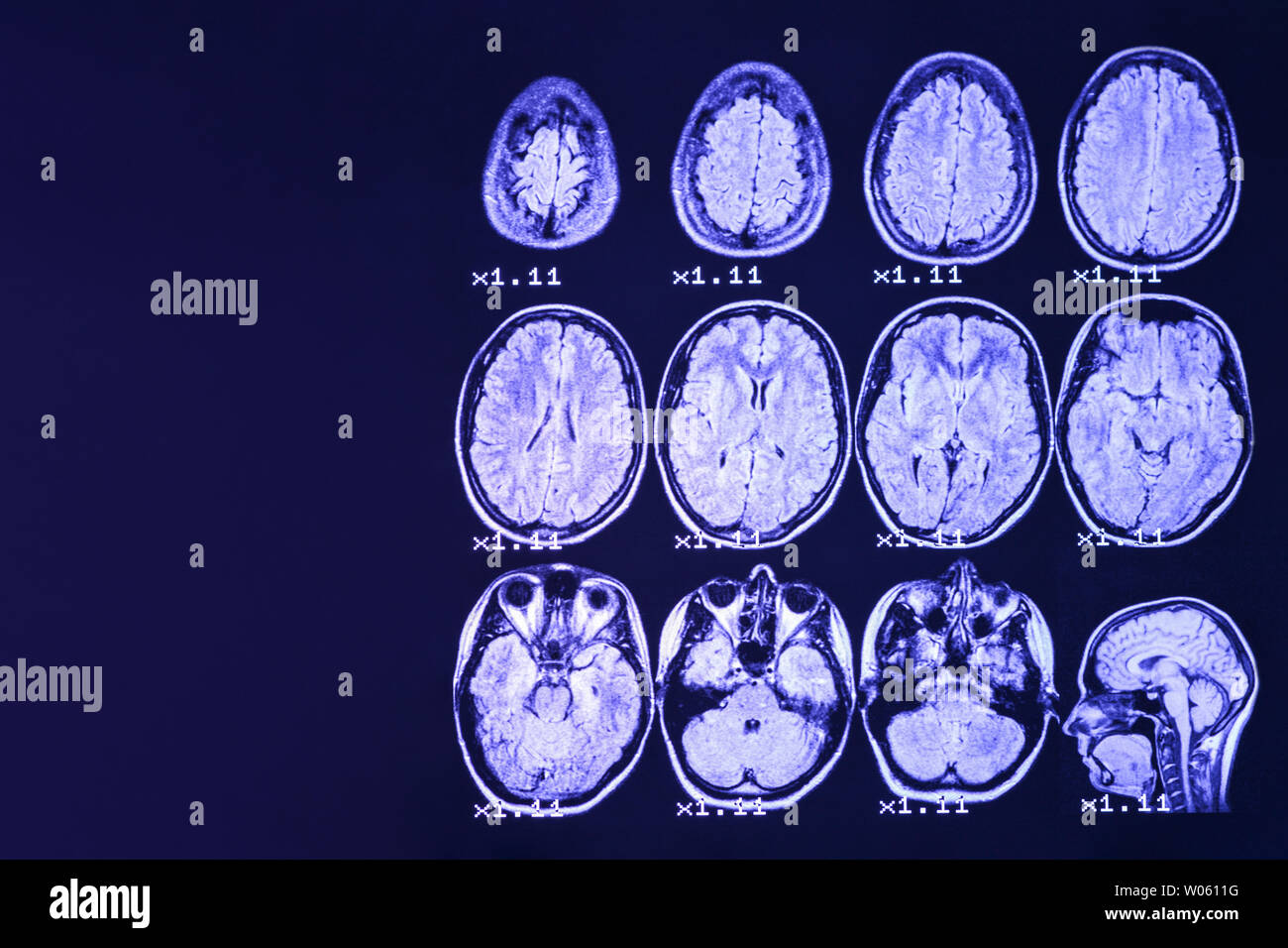 MRI del cervello su uno sfondo nero con retroilluminazione blu. Il posto giusto per pubblicità iscrizione Foto Stock