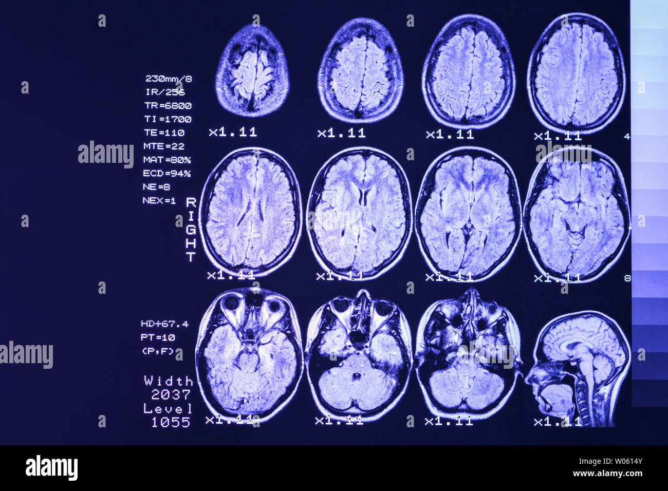 MRI scan o immagini a risonanza magnetica della testa e del cervello scansione. Il risultato è un MRI del cervello con i valori e i numeri con retroilluminazione a lilla. Foto Stock