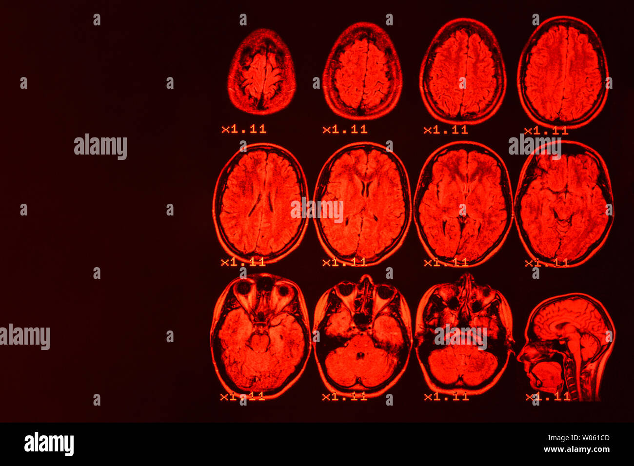 MRI del cervello su uno sfondo nero con retroilluminazione rossa. Medico di fondo Foto Stock