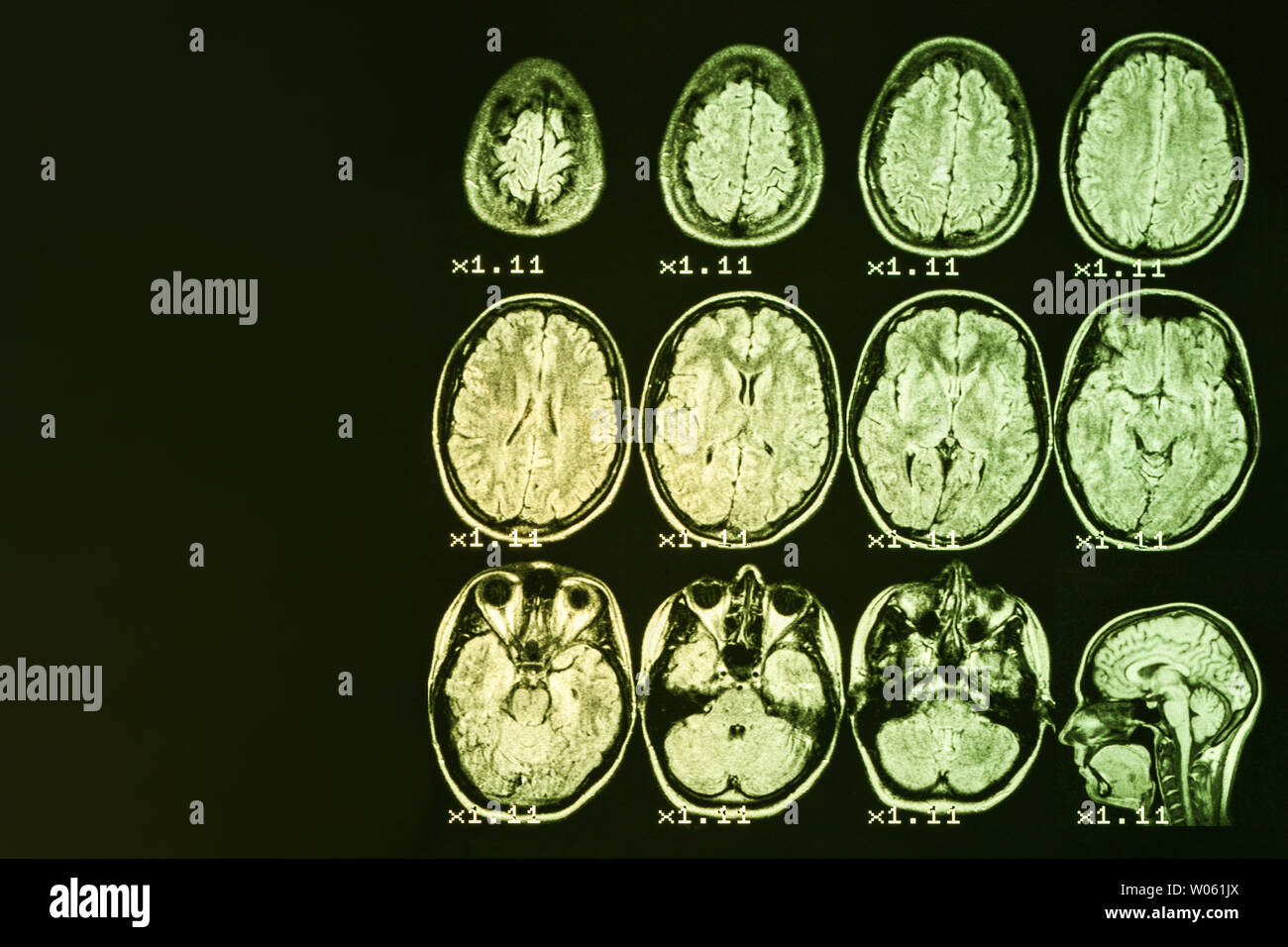 MRI del cervello su uno sfondo nero con retroilluminazione di colore giallo. Posto a sinistra per la pubblicità di iscrizione Foto Stock