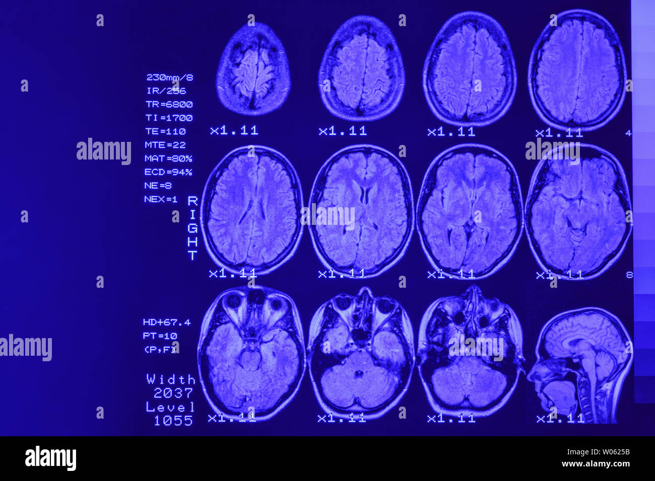 MRI scan o immagini a risonanza magnetica della testa e del cervello scansione. Il risultato è un MRI del cervello con i valori e i numeri con retroilluminazione blu. Foto Stock
