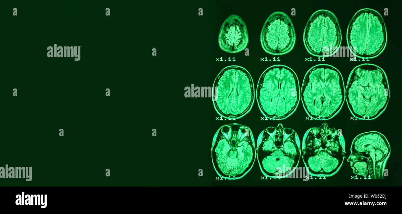 Banner. MRI del cervello di una persona sana su uno sfondo nero con retroilluminazione verde. Posto a sinistra per la pubblicità di iscrizione Foto Stock