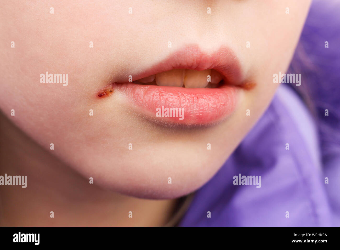 Herpes sulle labbra dei bambini. Unguento di trattamento. Foto Stock