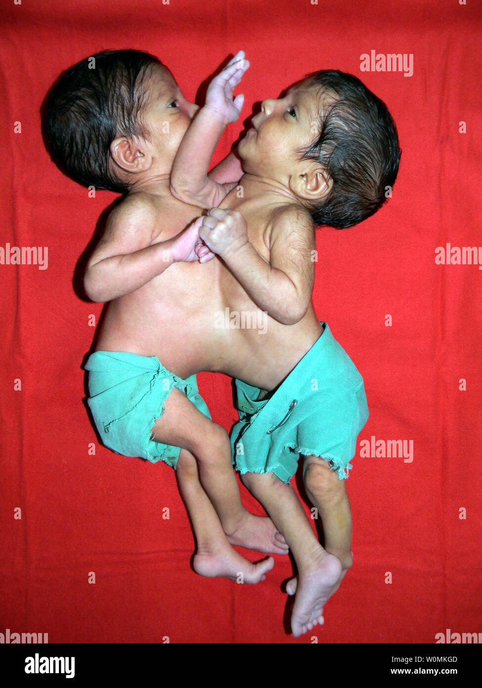 Precedentemente noto come gemelli siamesi, Stuti e Aradhana sono visti in questo pre-operazione file foto all'ospedale missionario in Padhar, Betul, in India centrale. L'uno-anno-vecchi sono stati separati con successo dopo una 12 Ore di chirurgia su Giugno 20, 2012, condotta da un team di 34 esperti medici, compresi 23 medici, disegnato da India e all'estero.L'uno-anno-vecchio sorelle sono state riunite nel cuore e fegato. UPI Photo/ STR. . Foto Stock